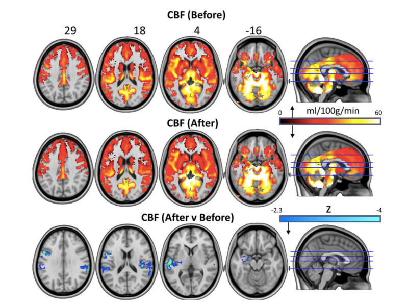 Illustration for article titled Magic Mushroom Chemical Appears to Physically Change Depressed Brains
